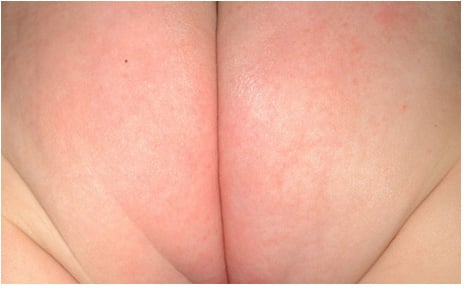 pinworm rash on bottom