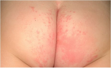 staph infection diaper rash